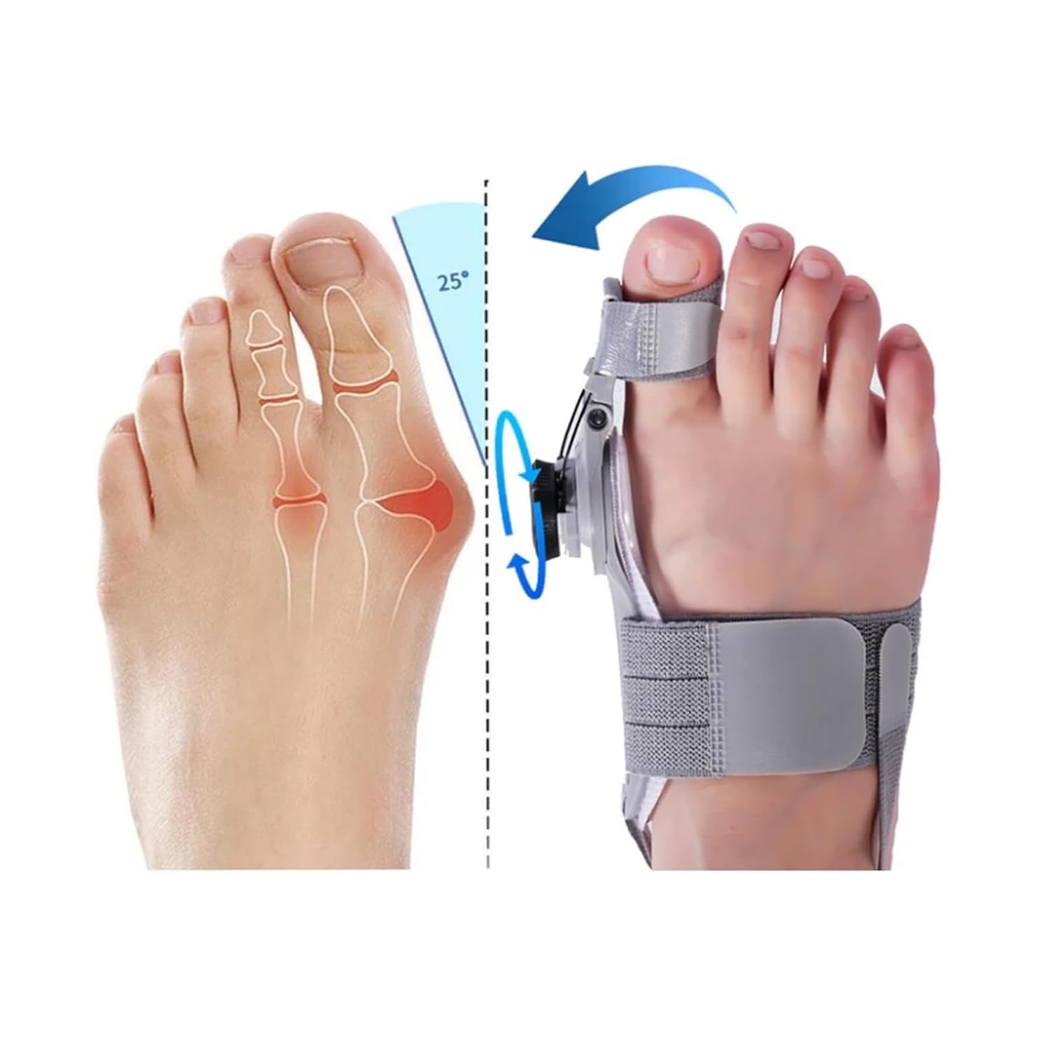 Correcteur Orthopédique Hallux Valgus Ajustable – Soulagement & Alignement Instantané