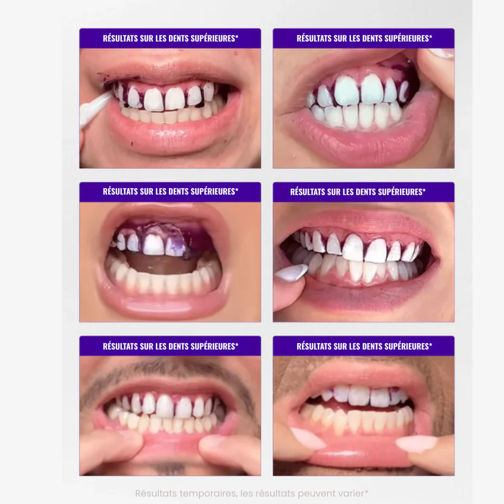 Bandes Blanchissantes Violettes V34 – Sourire Blanc Instantané en 30 Minutes