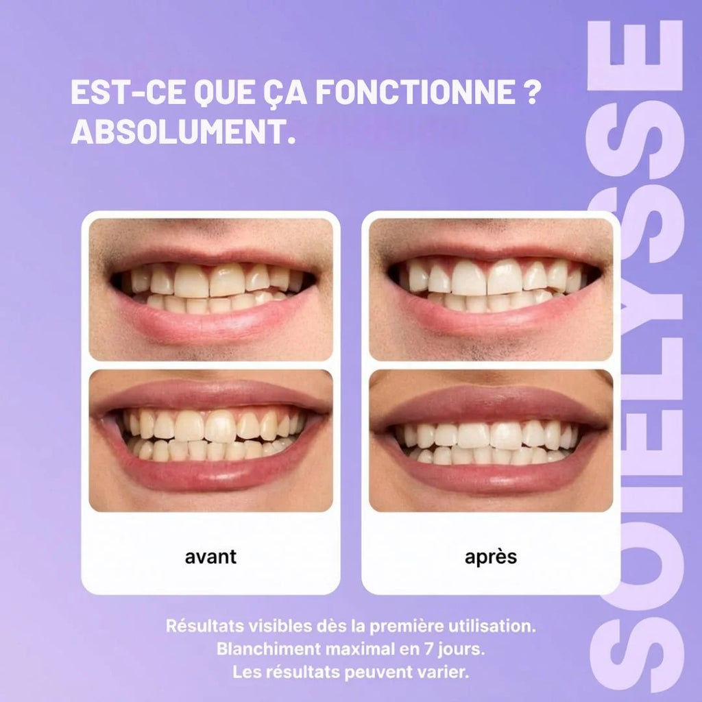 Bandes Blanchissantes Violettes V34 – Sourire Blanc Instantané en 30 Minutes